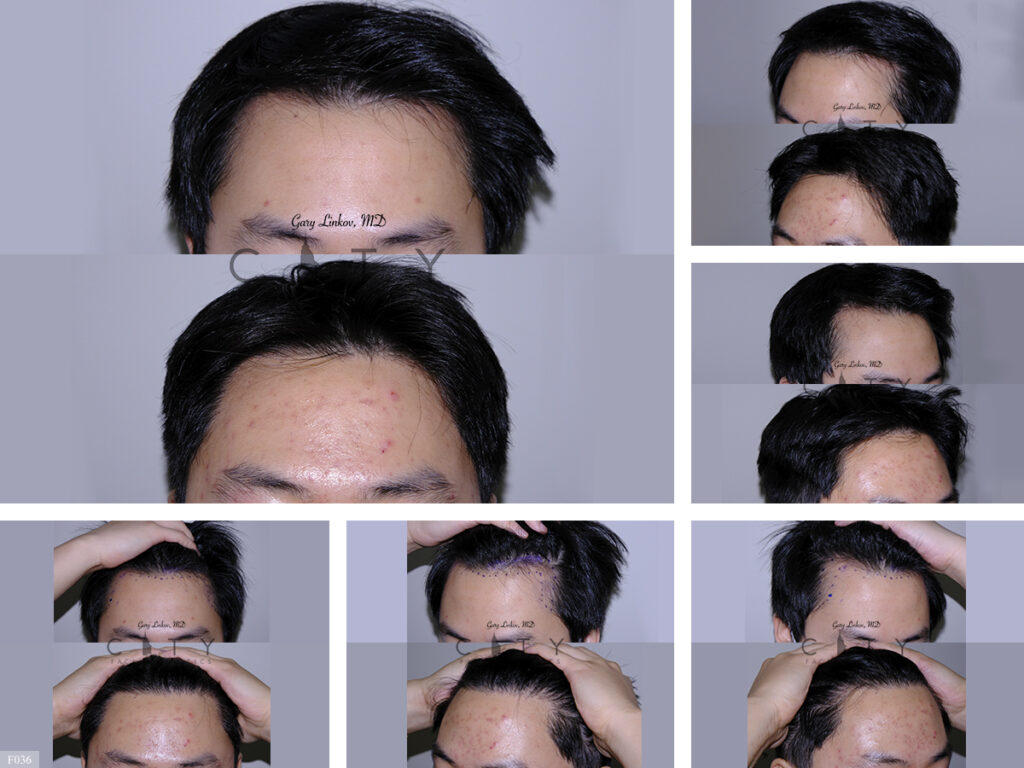 Hair Transplant F036