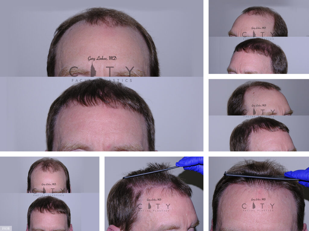 Hair Transplant F038