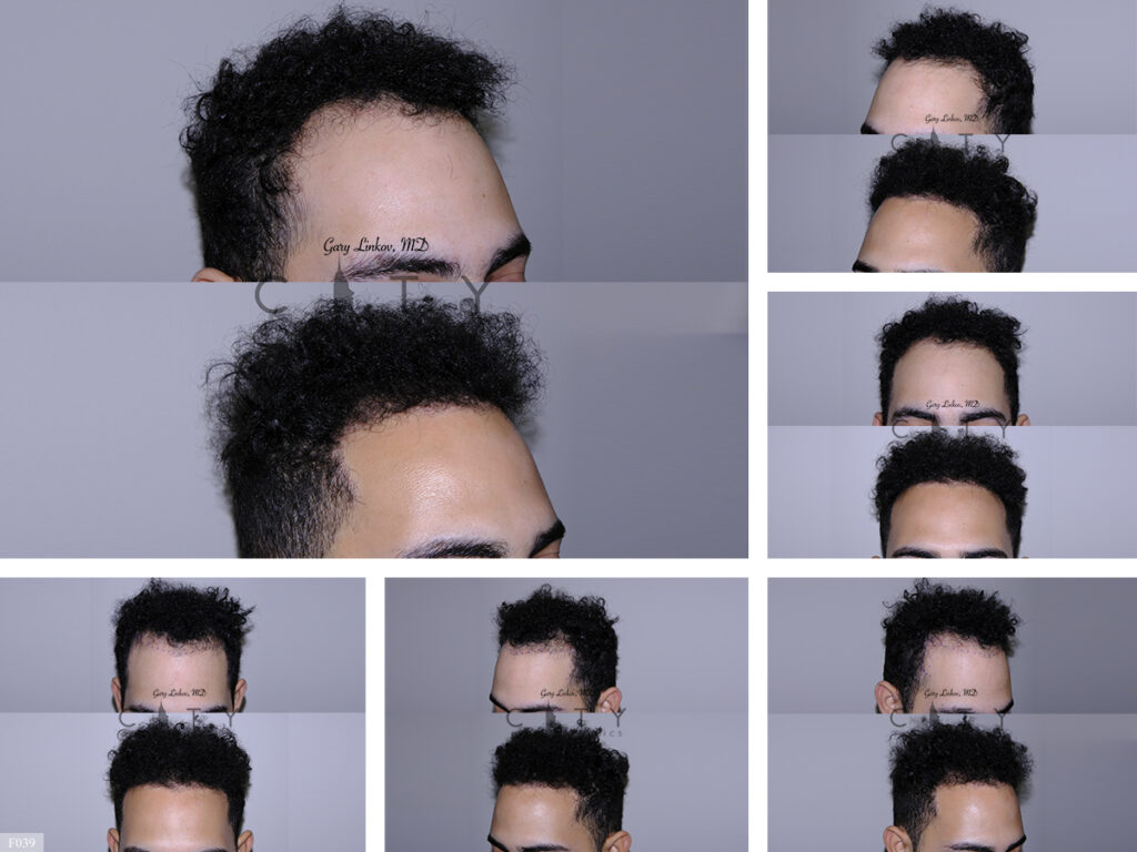 Hair Transplant F039