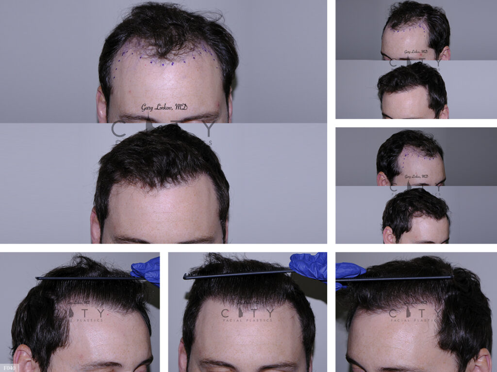Hair Transplant F040