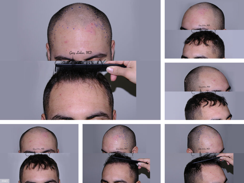 Hair Transplant F043