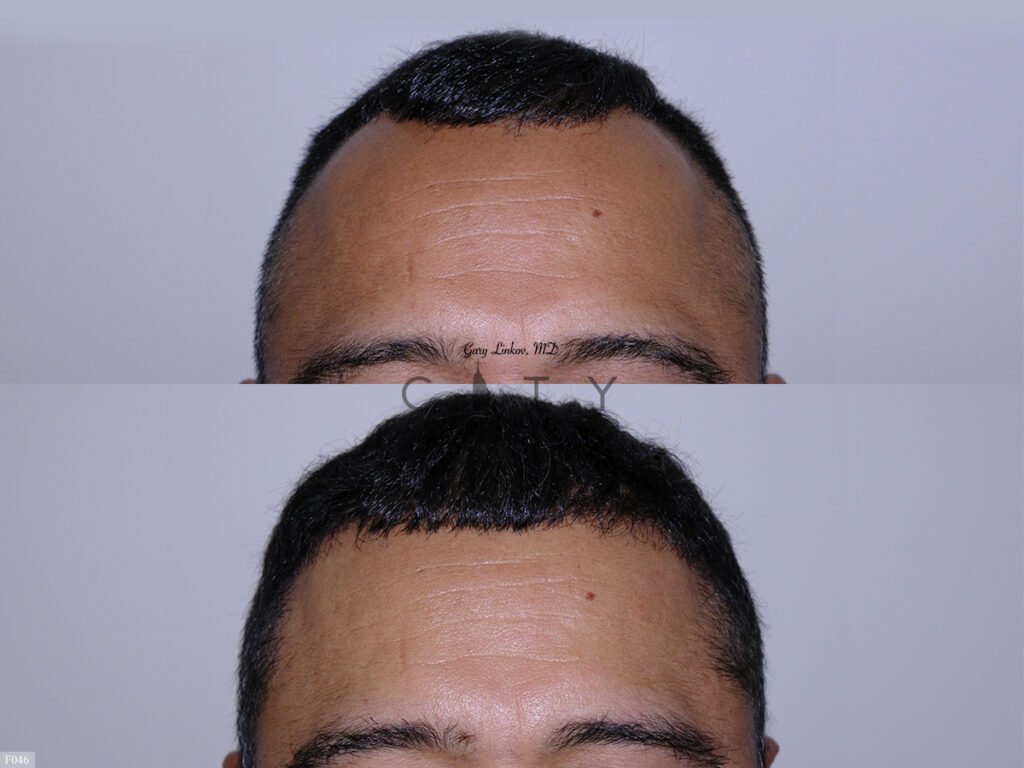 Hair Transplant F046