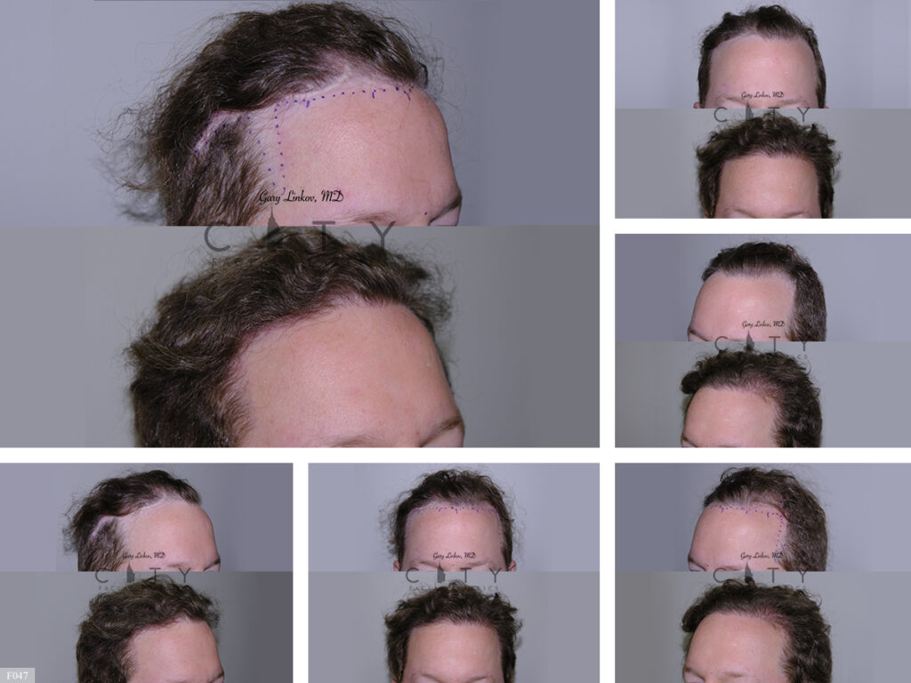 Hair Transplant F047