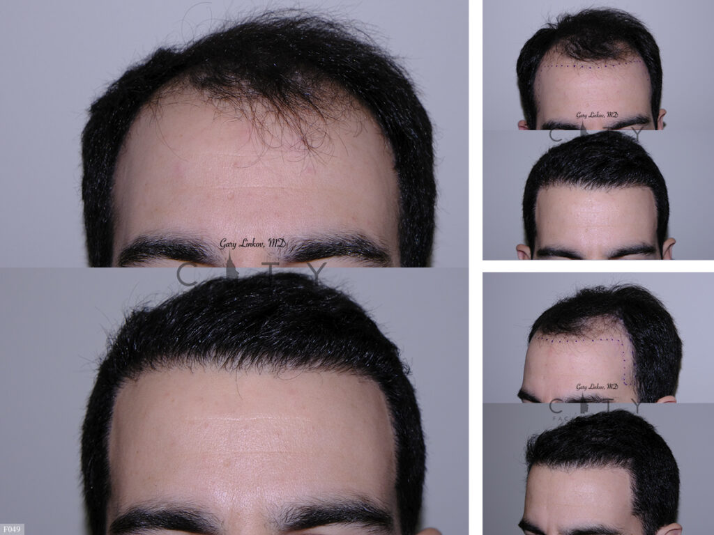 Hair Transplant F049