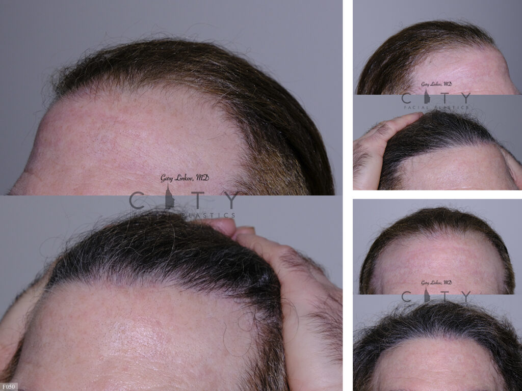 Hair Transplant F050