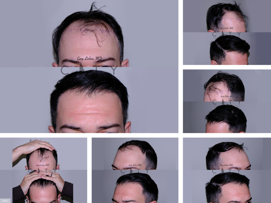 Hair Transplant_F051