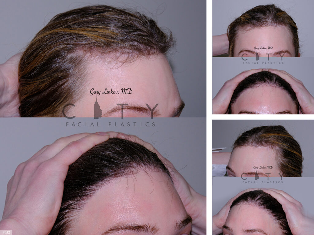 Hair Transplant_F052