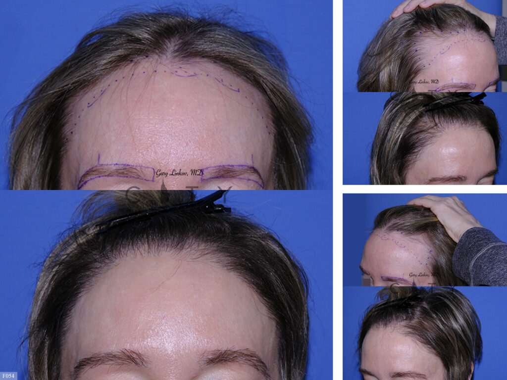 Hair Transplant_F054