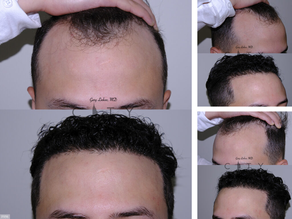 Hair Transplant F056