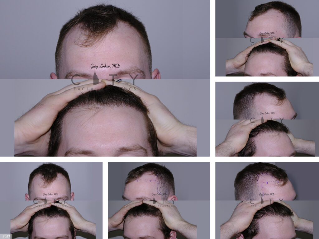 Hair Transplant F057
