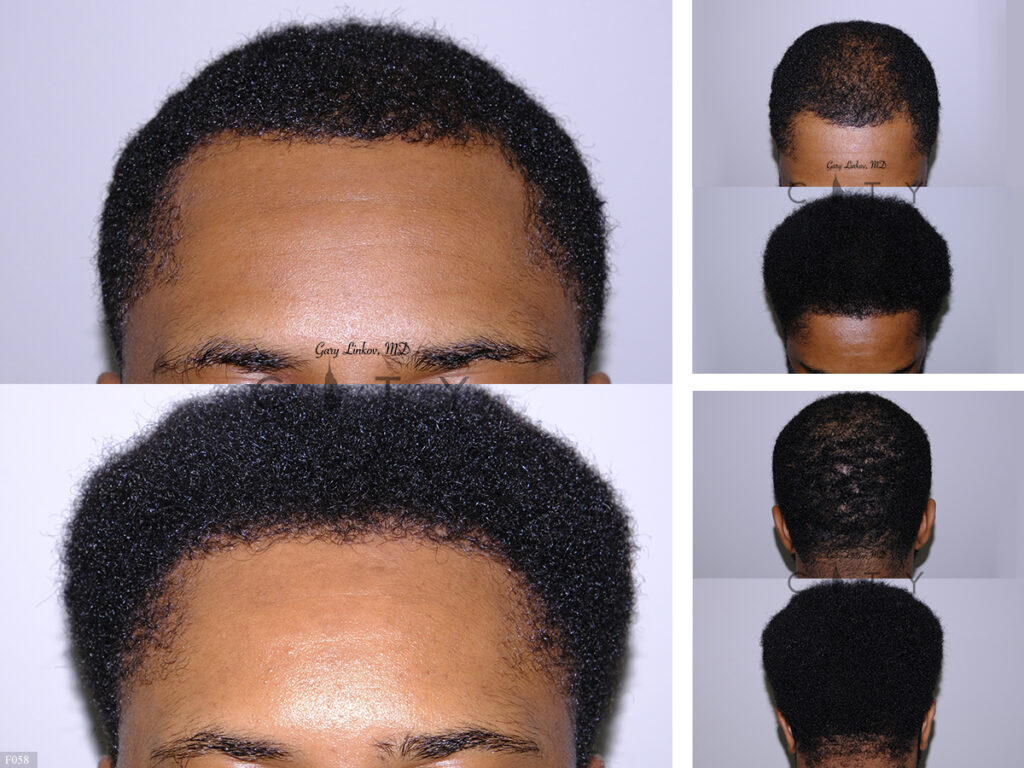 Hair Transplant F058