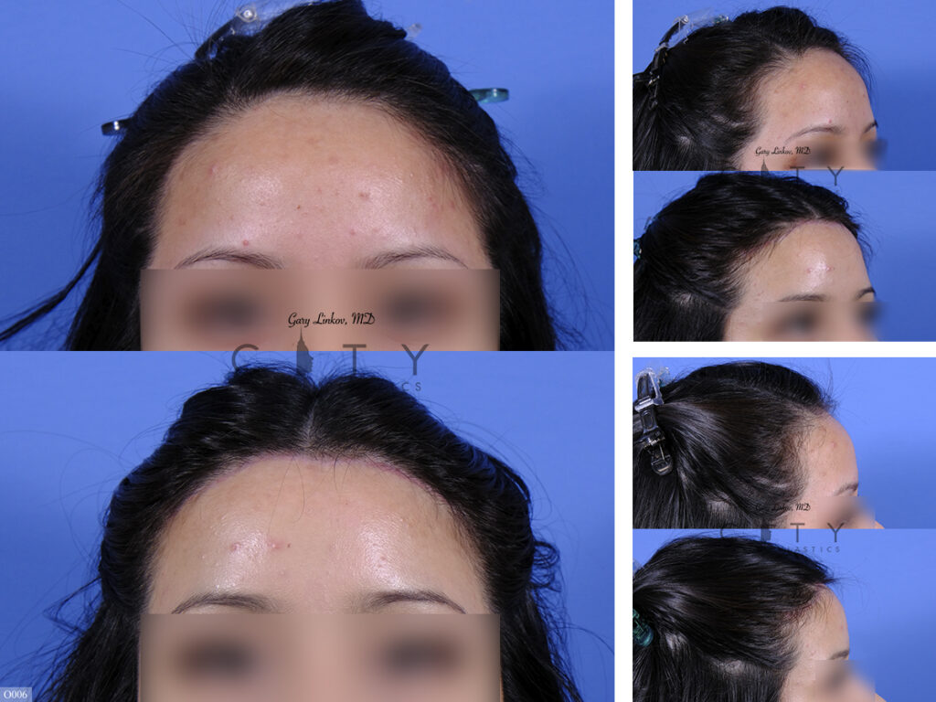 Surgical Hairline Advancement O006