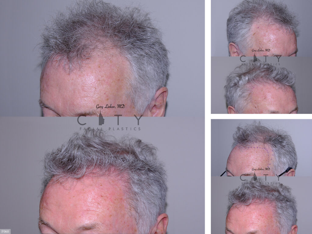 Hair Transplant F060