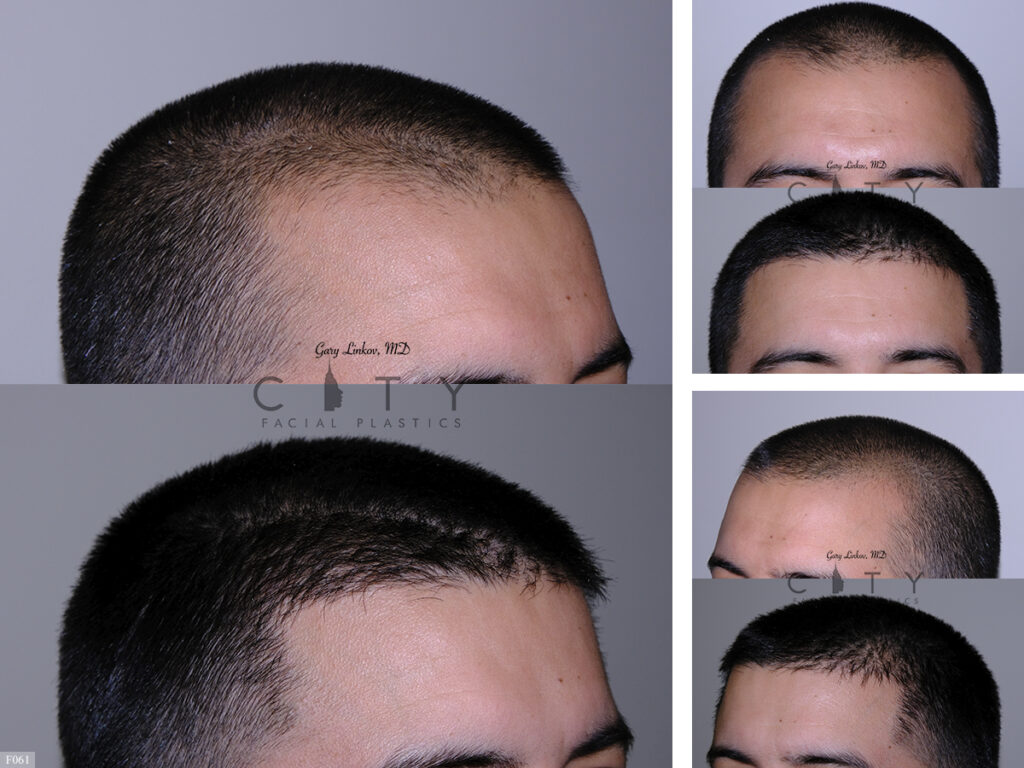 Hair Transplant F061