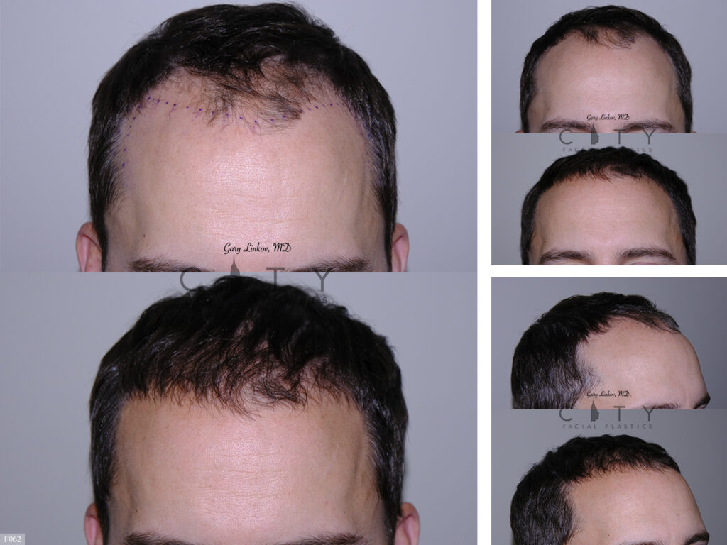 Hair Transplant F062