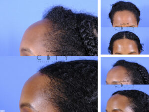 Surgical Hairline Advancement O007