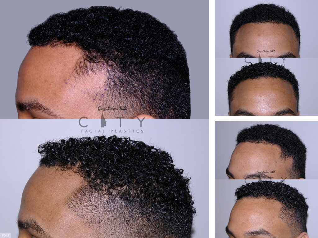 Hair Transplant F063