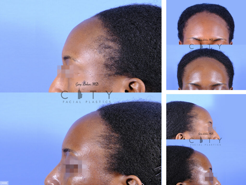 Surgical Hairline Advancement O008