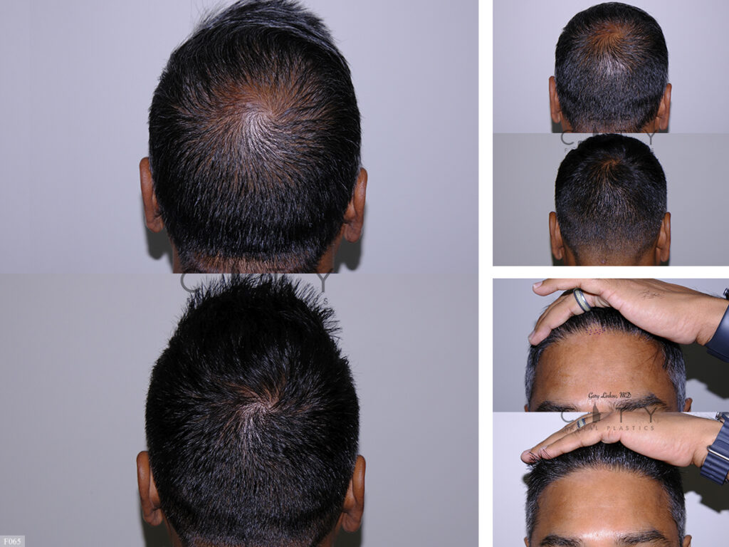 Hair Transplant F065