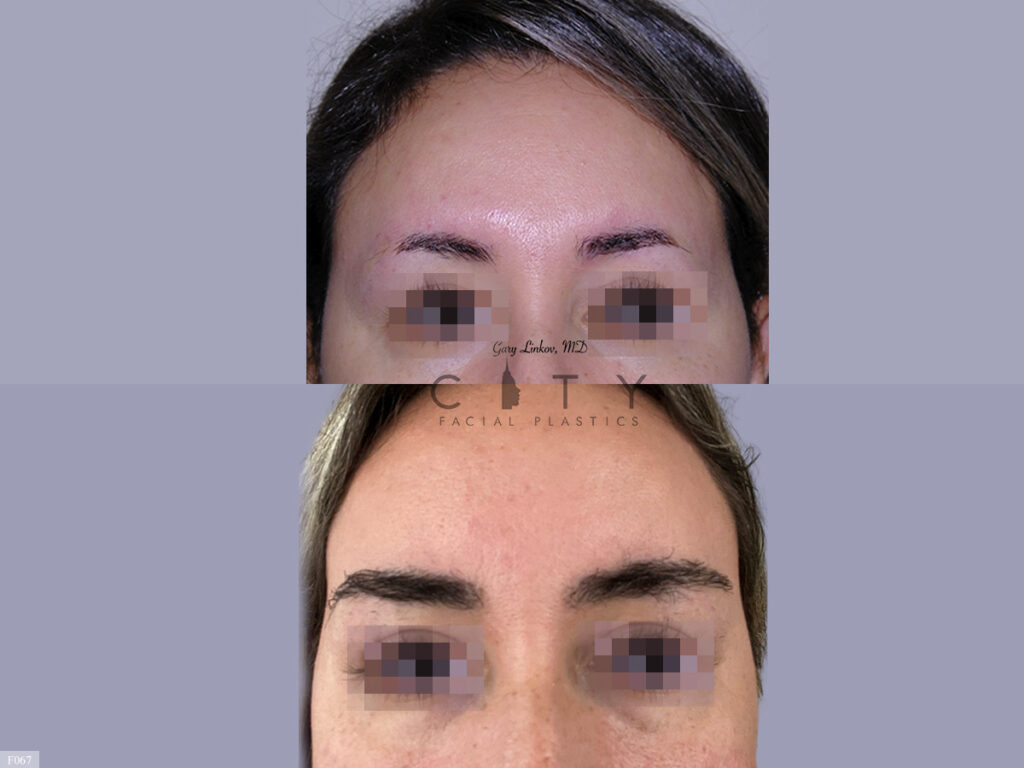 Hair Transplant F067