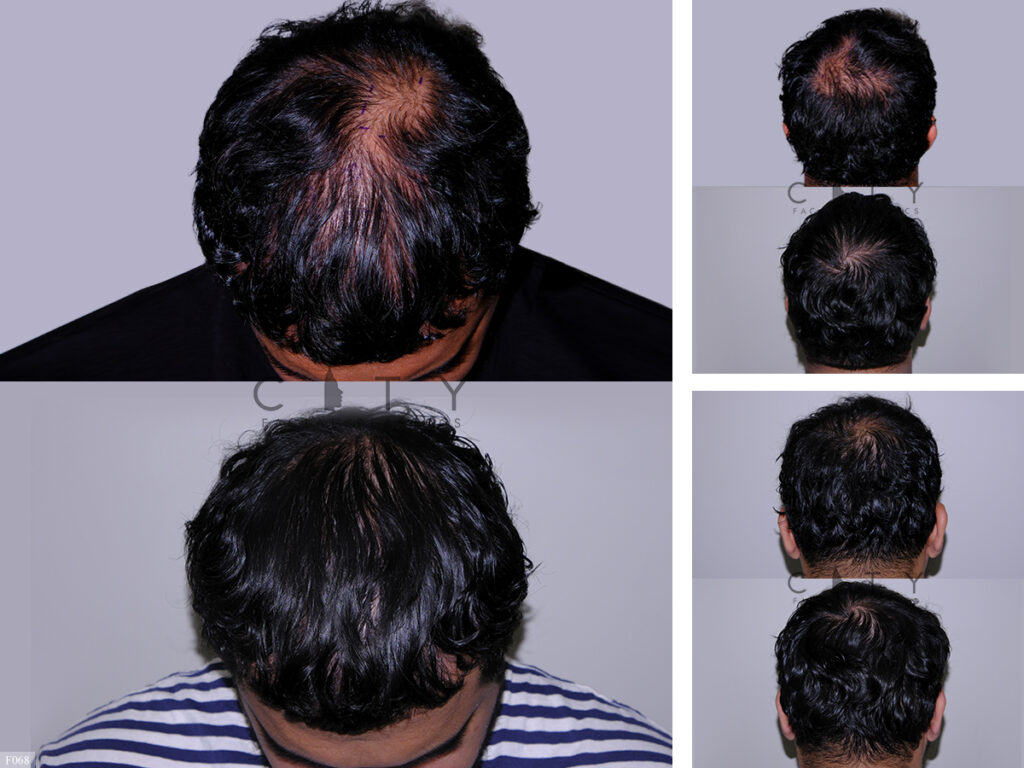 Hair Transplant F068