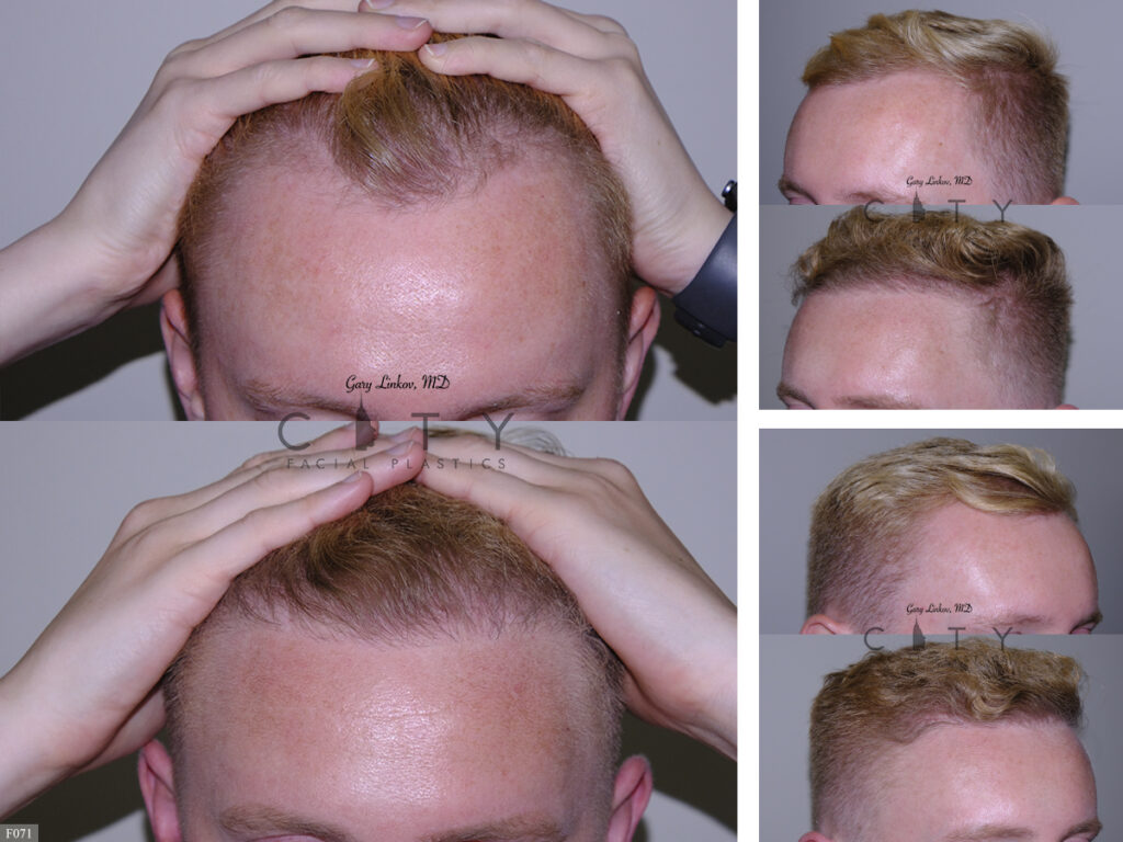 Hair Transplant F071