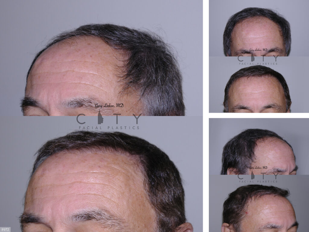 Hair Transplant F072