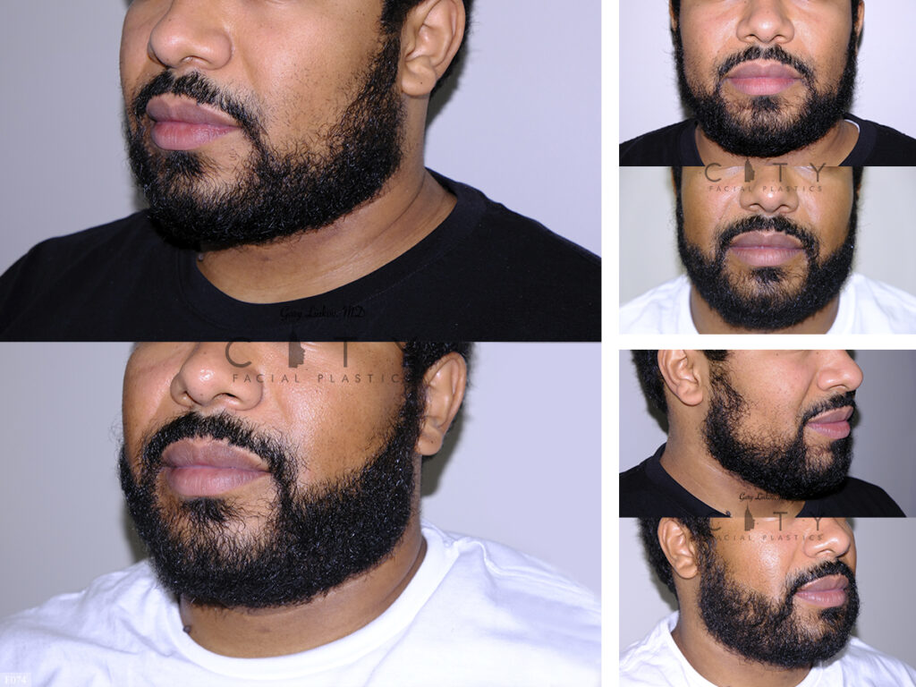 Hair Transplant F074