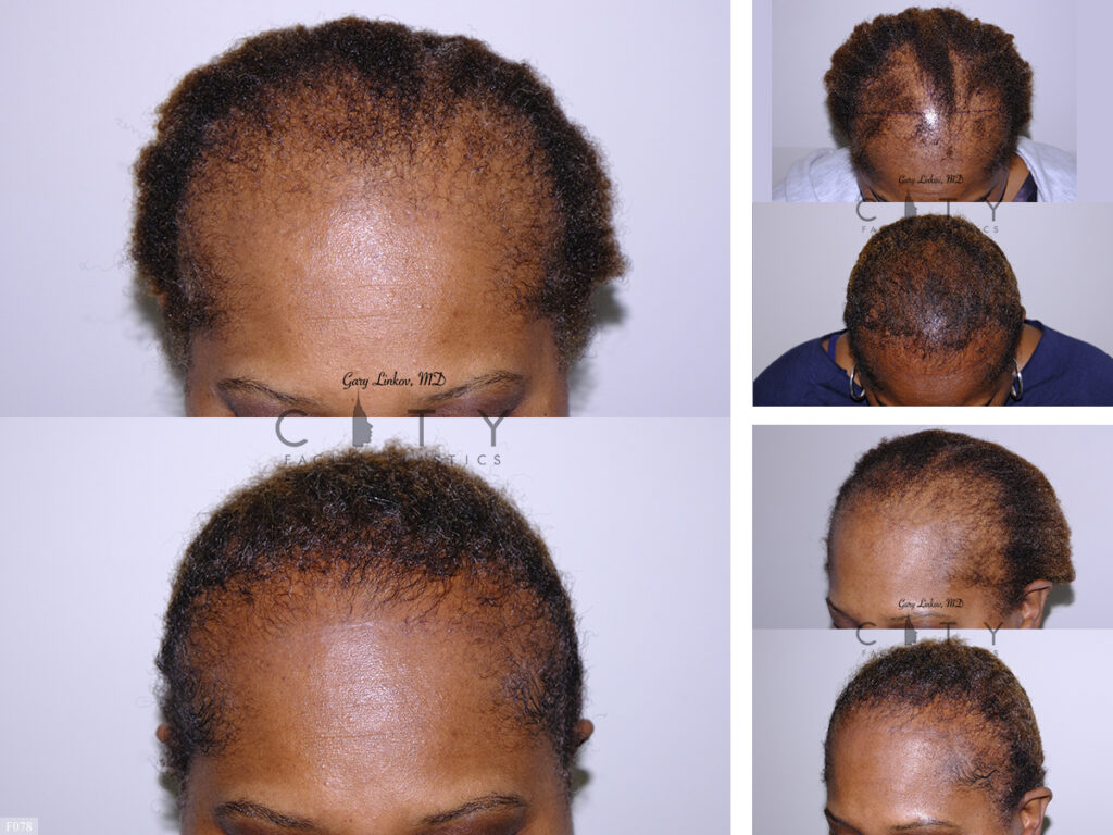 Hair Transplant F078