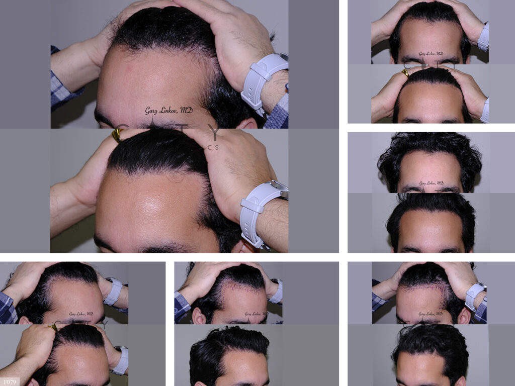 Hair Transplant F079