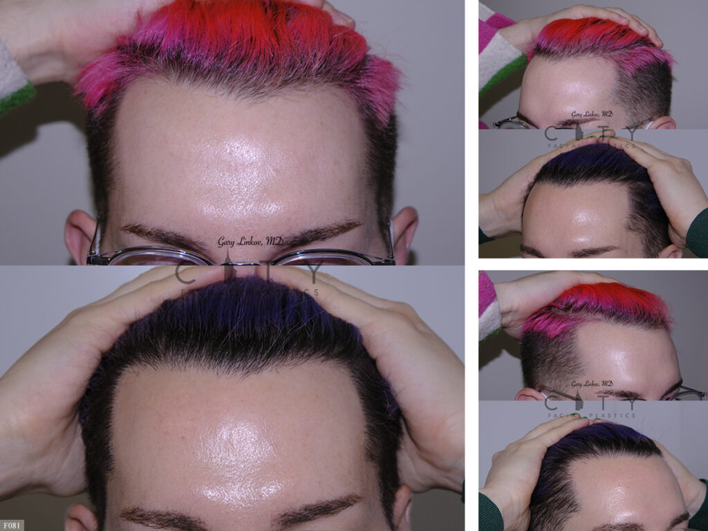 Hair Transplant F081