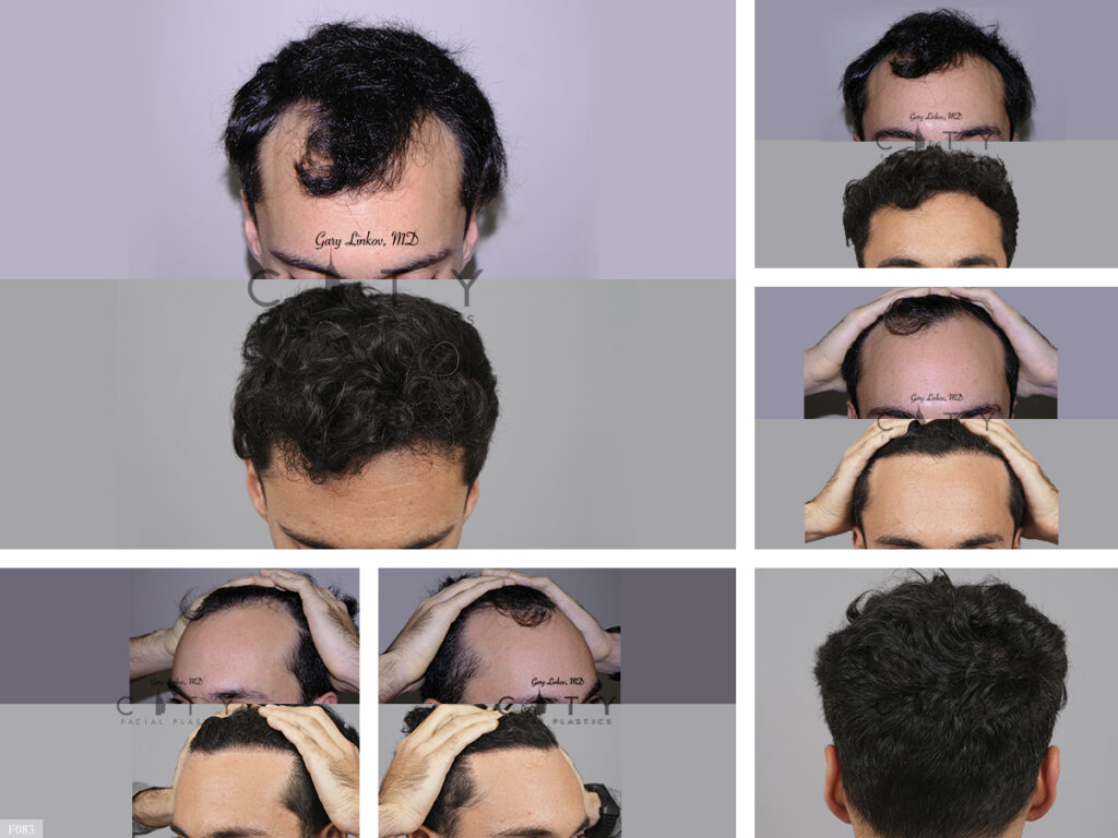 Hair Transplant F083