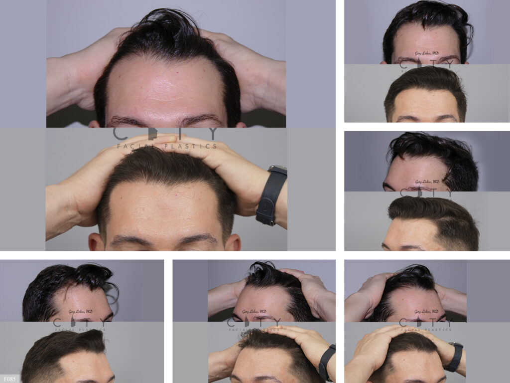 Hair Transplant F085