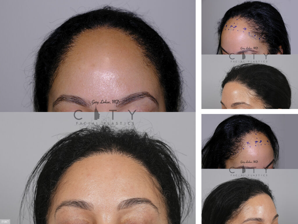 Hair Transplant F087