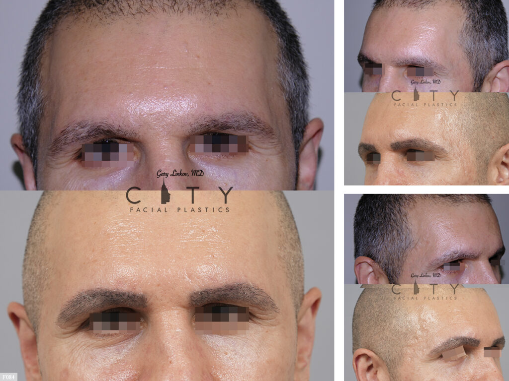 Hair Transplant F084