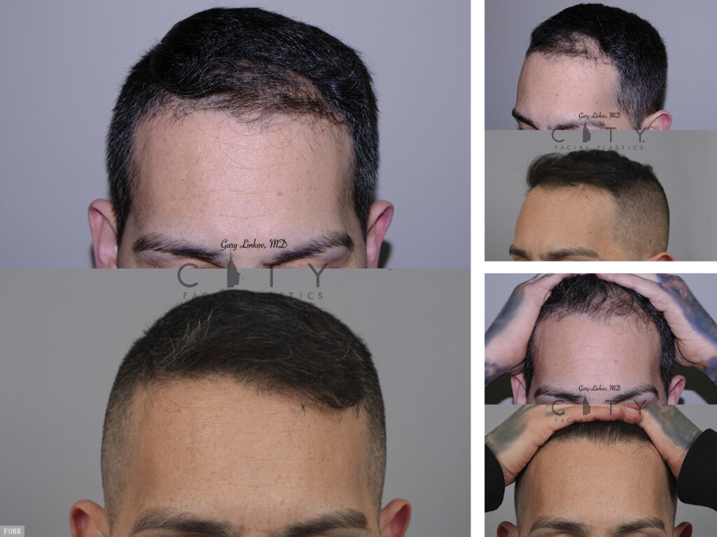 Hair Transplant F088