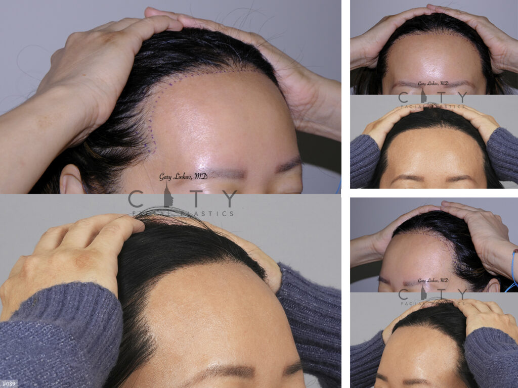 Hair Transplant F089