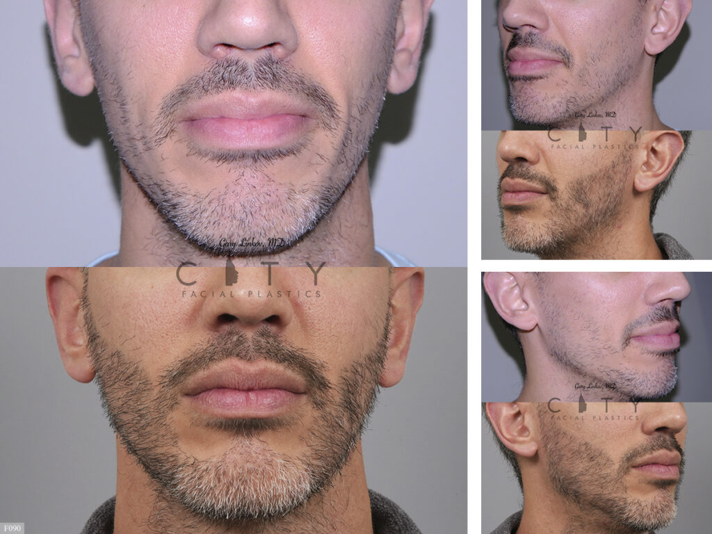 Hair Transplant F090