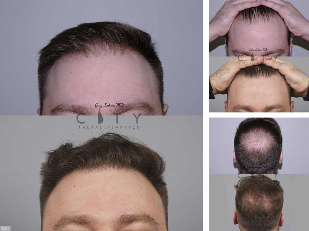 Hair Transplant F091