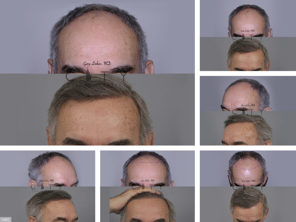 Hair Transplant F093