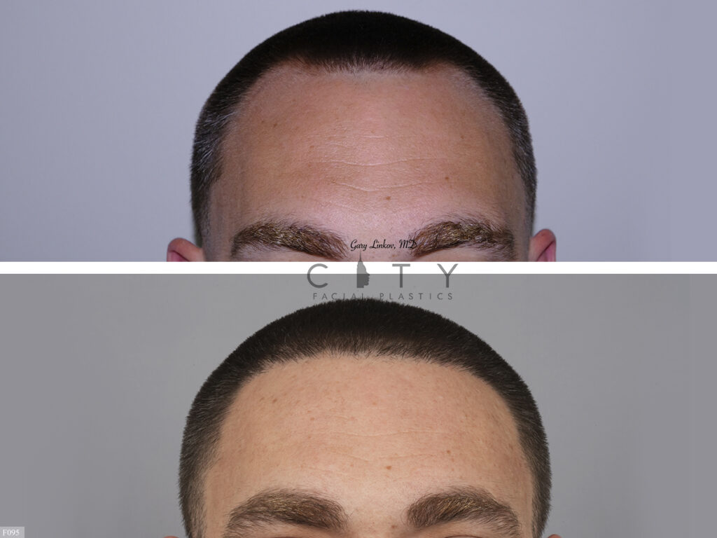 Hair Transplant F095
