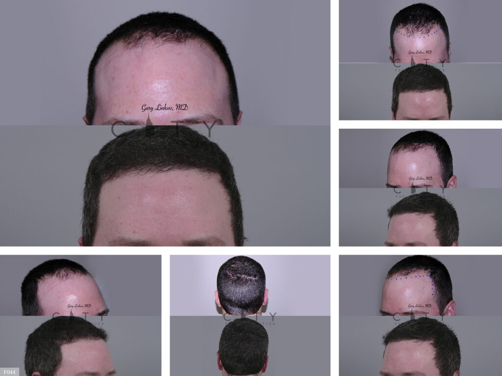 Hair Transplant F044