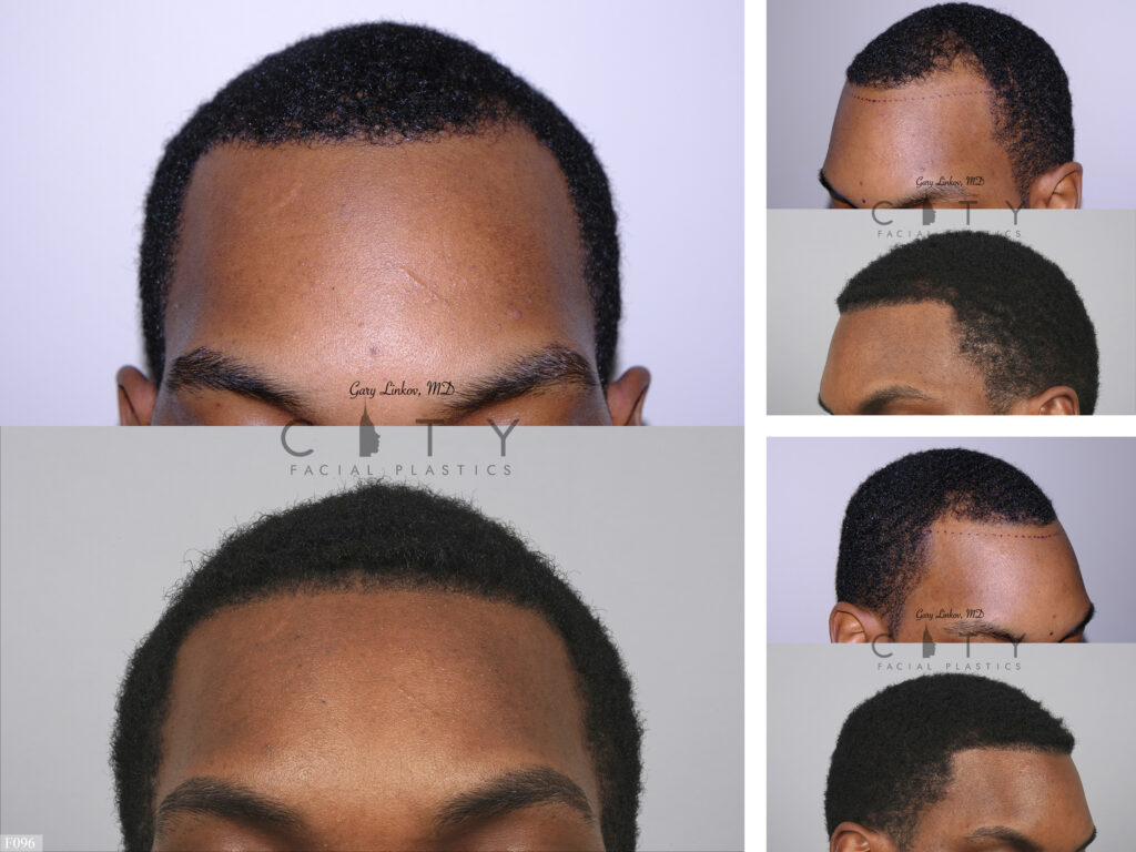 Hair Transplant F096