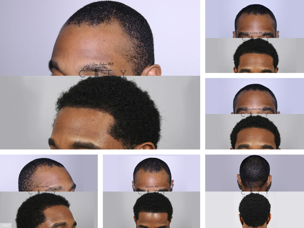 Hair Transplant F097