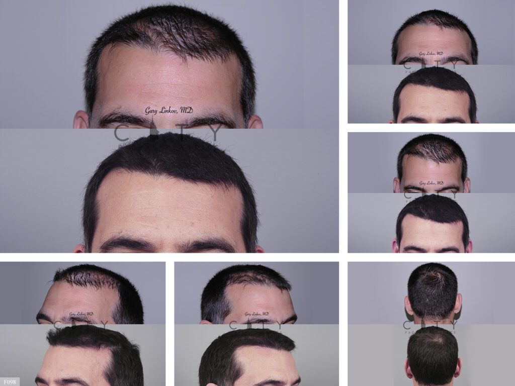 Hair Transplant F098