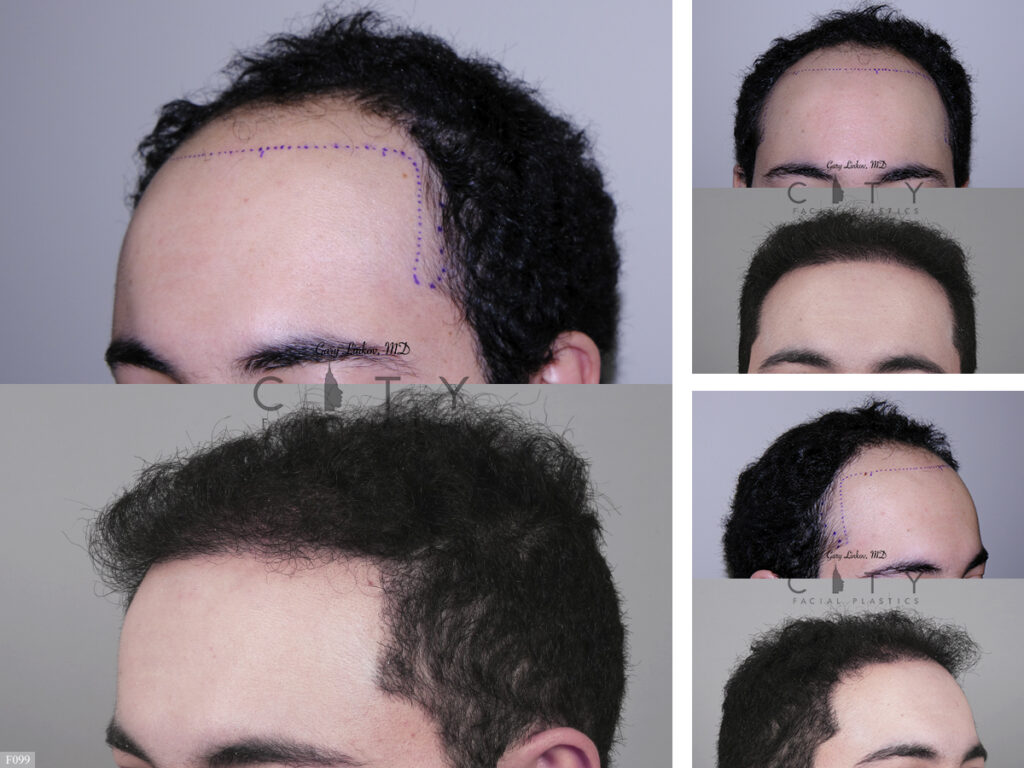 Hair Transplant F099