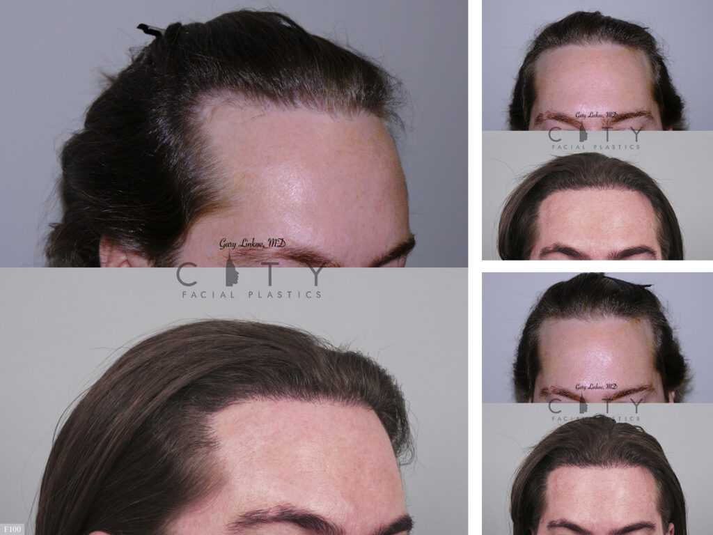Hair Transplant F100