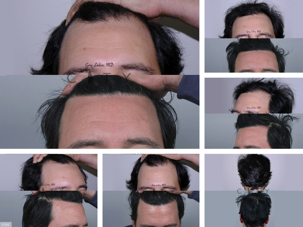 Hair Transplant F101