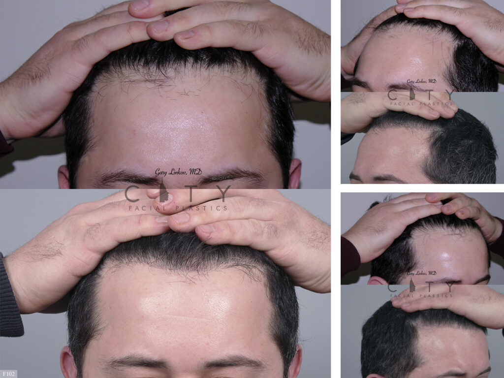 Hair Transplant F102