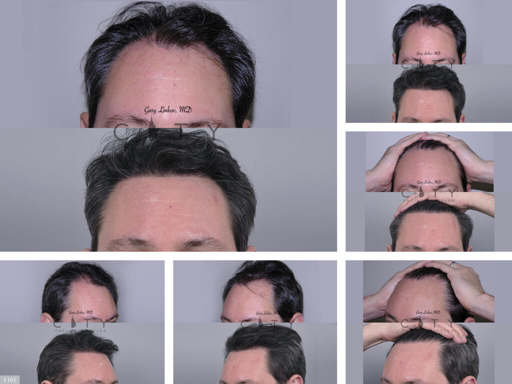 Hair Transplant F103
